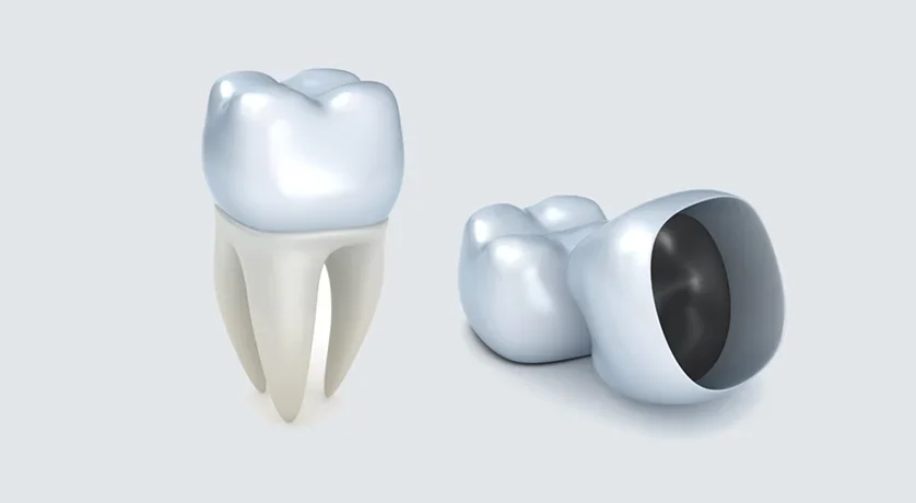 Dental Crowns