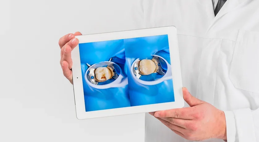 Dental Fillings