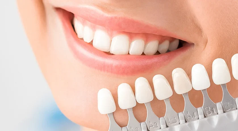 Dental Veneers