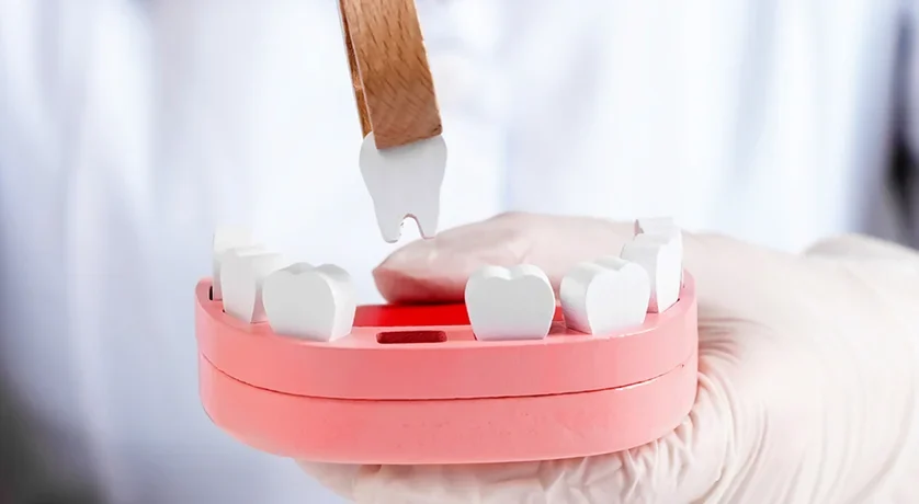 Tooth Extractions