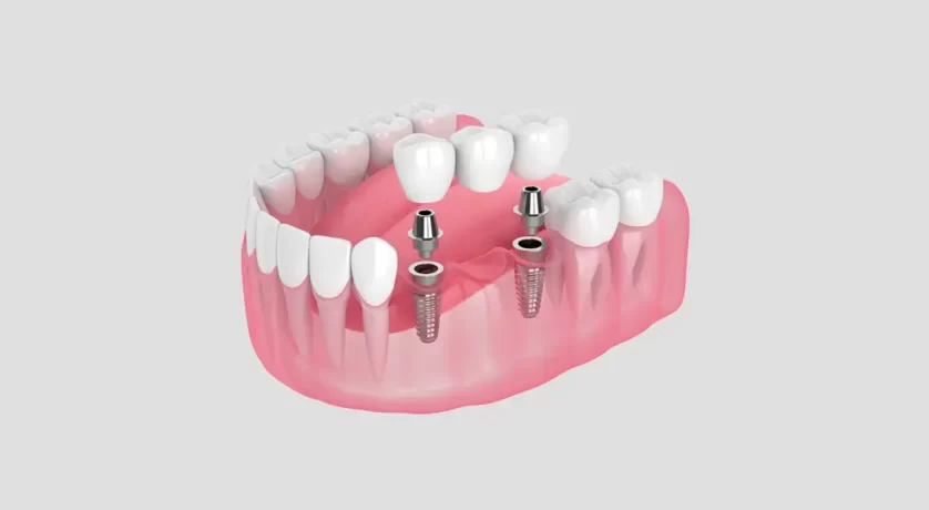 Dental Implants vs. Bridges: Which Option Is Right for Your Smile?
